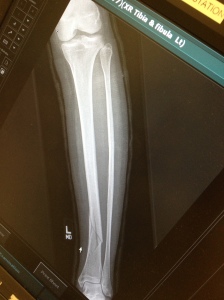 What a pretty fracture